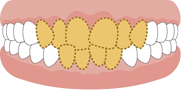 でこぼこ（叢生）の歯並びのイラスト
